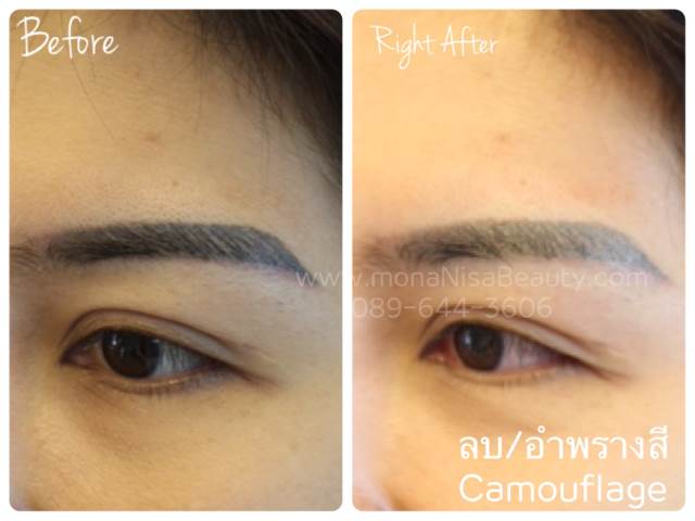 Cosmetic Tattoo Removal