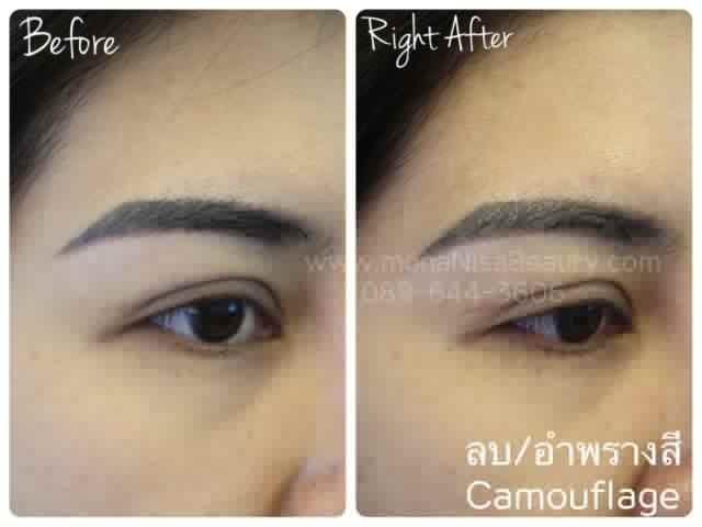 Cosmetic Tattoo Removal
