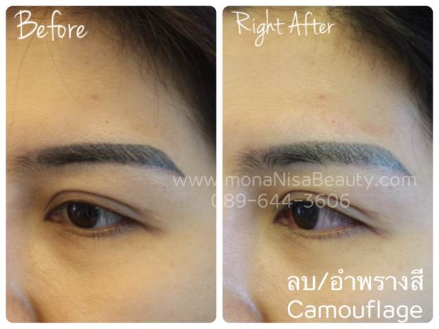 Cosmetic Tattoo Removal