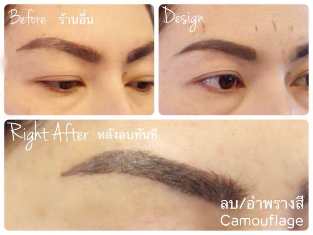 ลบรอยสักคิ้ว ตา ปาก