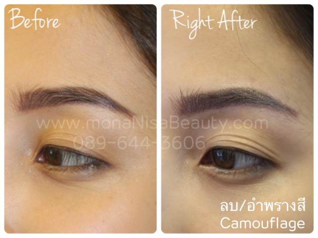 ลบรอยสักคิ้ว ตา ปาก