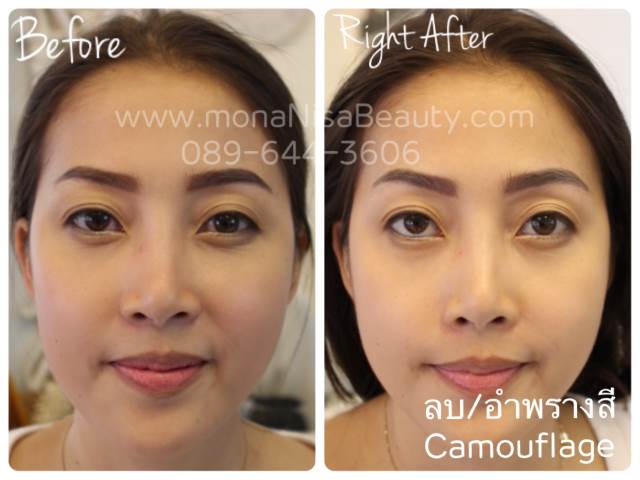 ลบรอยสักคิ้ว ตา ปาก