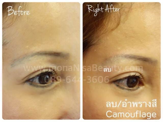Cosmetic Tattoo Removal