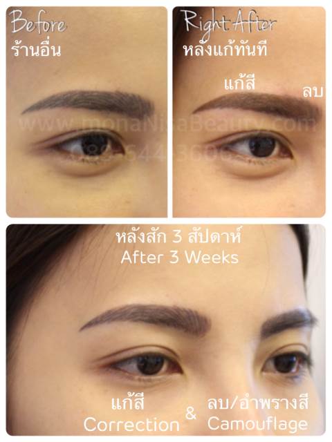 Cosmetic Tattoo Removal