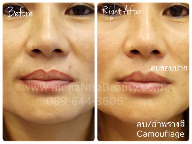 Cosmetic Tattoo Removal