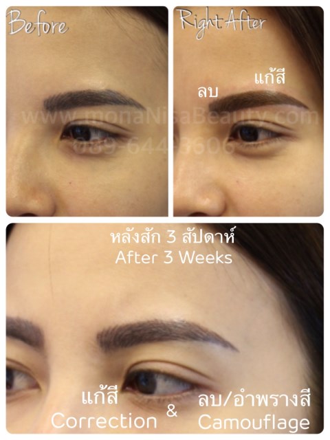 Cosmetic Tattoo Removal