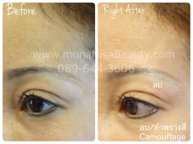 Cosmetic Tattoo Removal