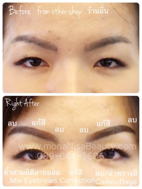 ลบรอยสักคิ้ว ตา ปาก