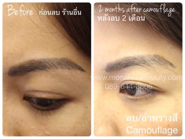 ลบรอยสักคิ้ว ตา ปาก