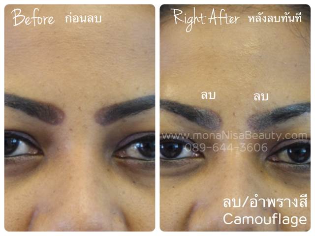 ลบรอยสักคิ้ว ตา ปาก