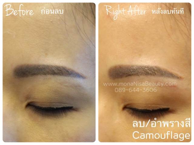 ลบรอยสักคิ้ว ตา ปาก