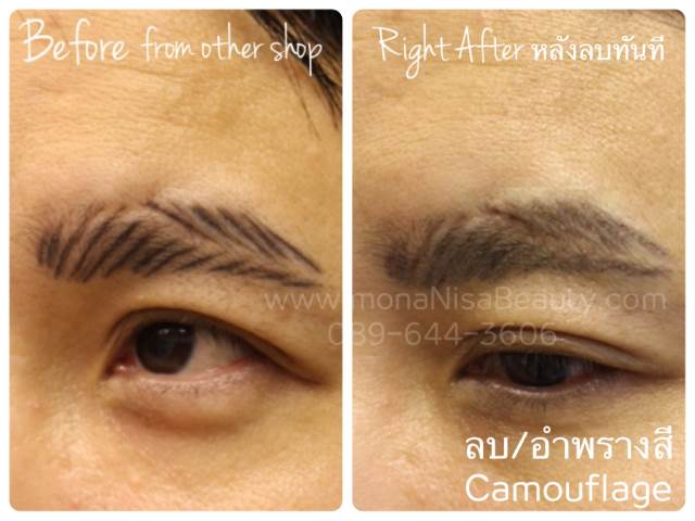 ลบรอยสักคิ้ว ตา ปาก