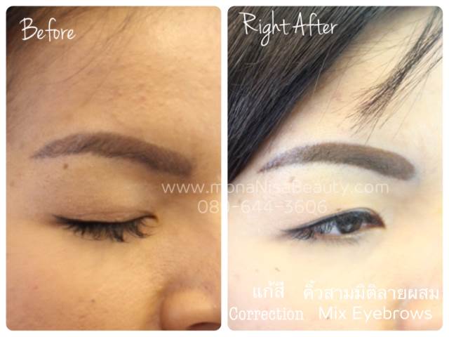 ลบรอยสักคิ้ว ตา ปาก