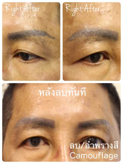 ลบรอยสักคิ้ว ตา ปาก