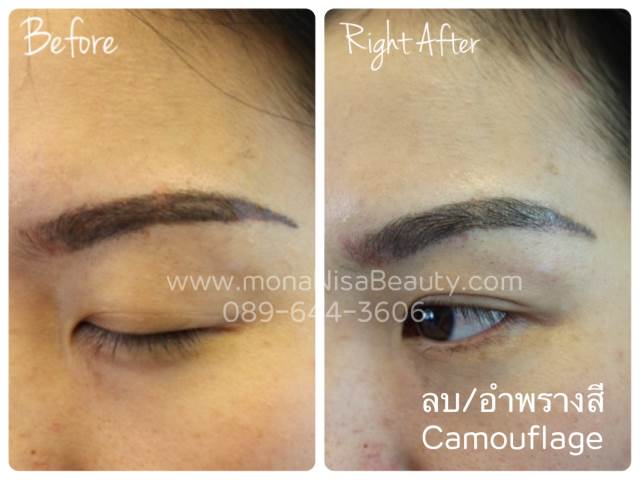 ลบรอยสักคิ้ว ตา ปาก