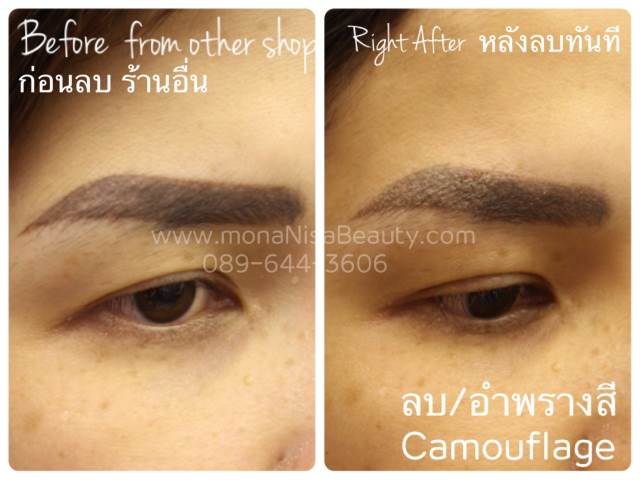 ลบรอยสักคิ้ว ตา ปาก