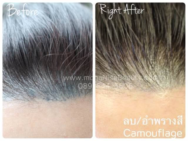 View Only Photos Of Correction And Removal Of 3d Eyebrow Tattoo
