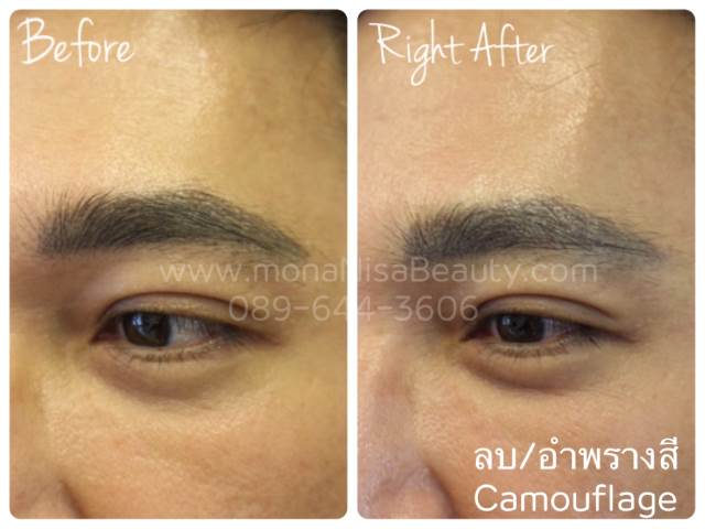 ลบรอยสักคิ้ว ตา ปาก