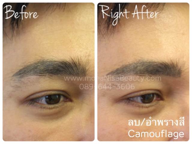 ลบรอยสักคิ้ว ตา ปาก