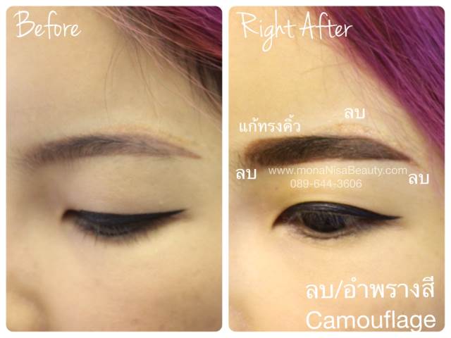 ลบรอยสักคิ้ว ตา ปาก