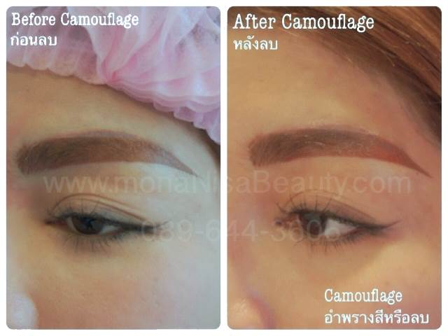Cosmetic Tattoo Removal