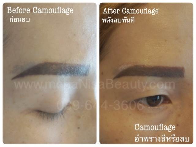 Cosmetic Tattoo Removal