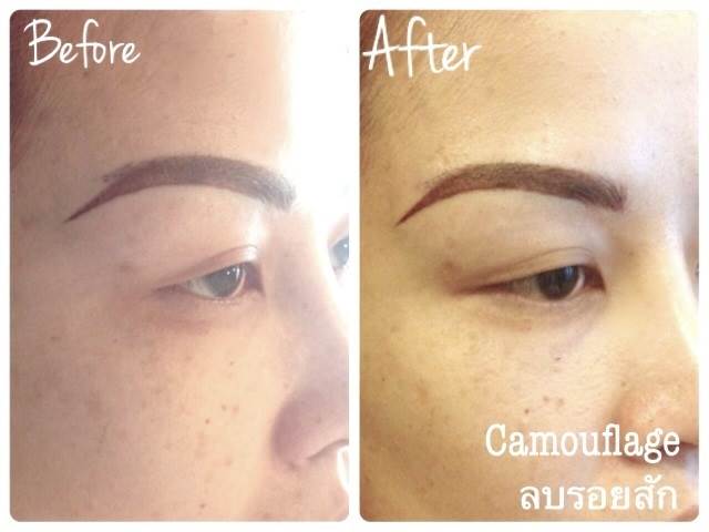 Cosmetic Tattoo Removal