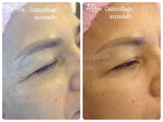 Cosmetic Tattoo Removal
