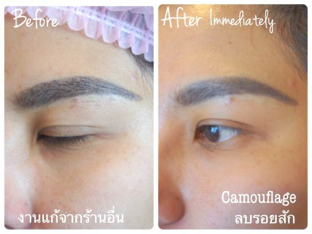 Cosmetic Tattoo Removal