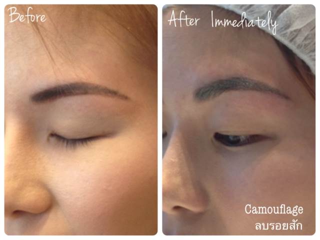 Cosmetic Tattoo Removal