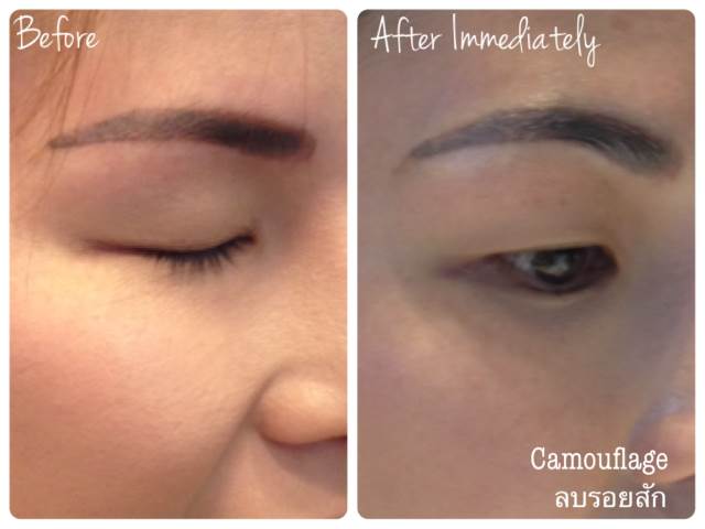 Cosmetic Tattoo Removal