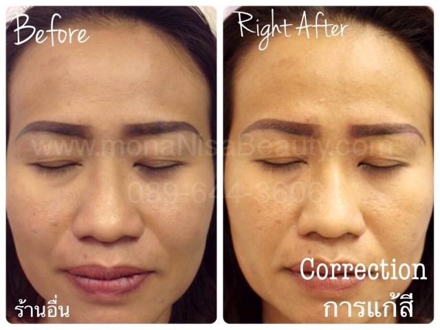 Cosmetic Tattoo Removal