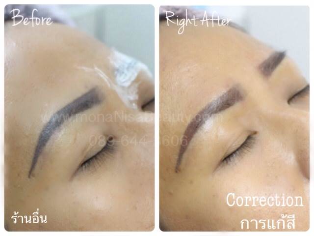 Cosmetic Tattoo Removal