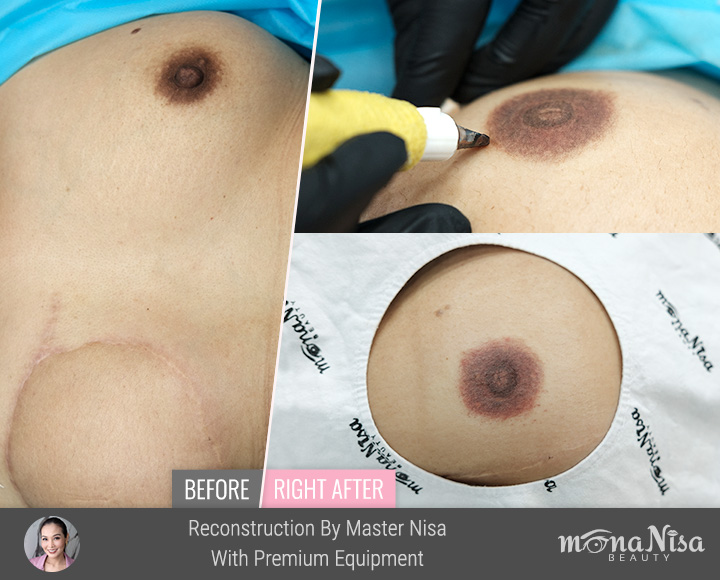 ภาพก่อน-หลังทำทันที และหลังเติมสีการสักหัวนม เต้านม หลังผ่าตัดเต้านม